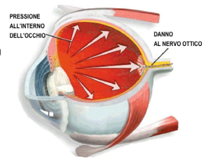 glaucoma-torino